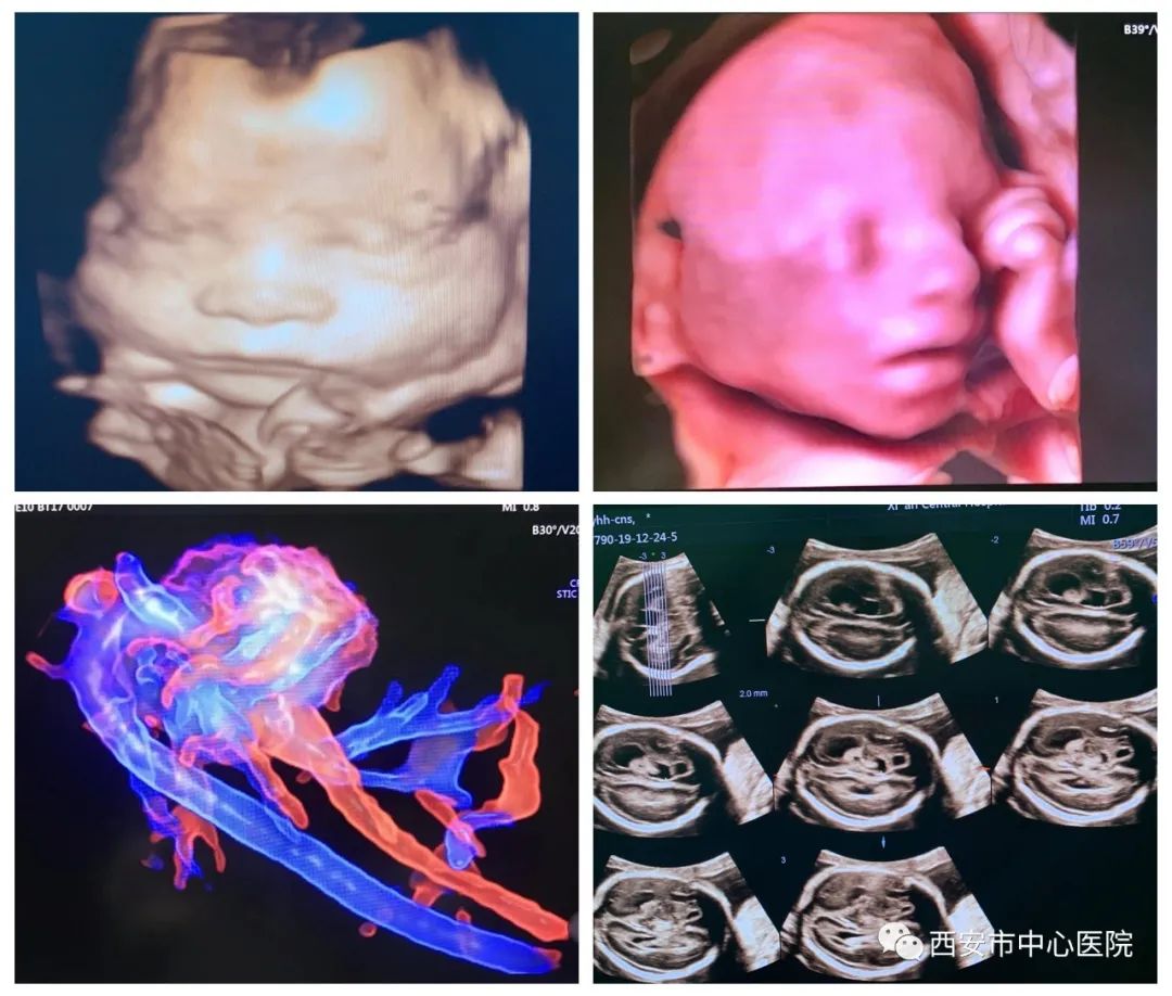 孕期检查发现子宫畸形,孕期心脏彩超有异常怎么办