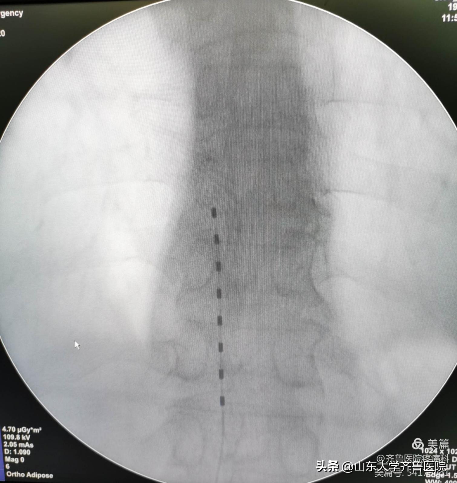疼痛门诊怎么治疗颈椎压迫脊髓,山东齐鲁医院颈脊髓损伤手术专家