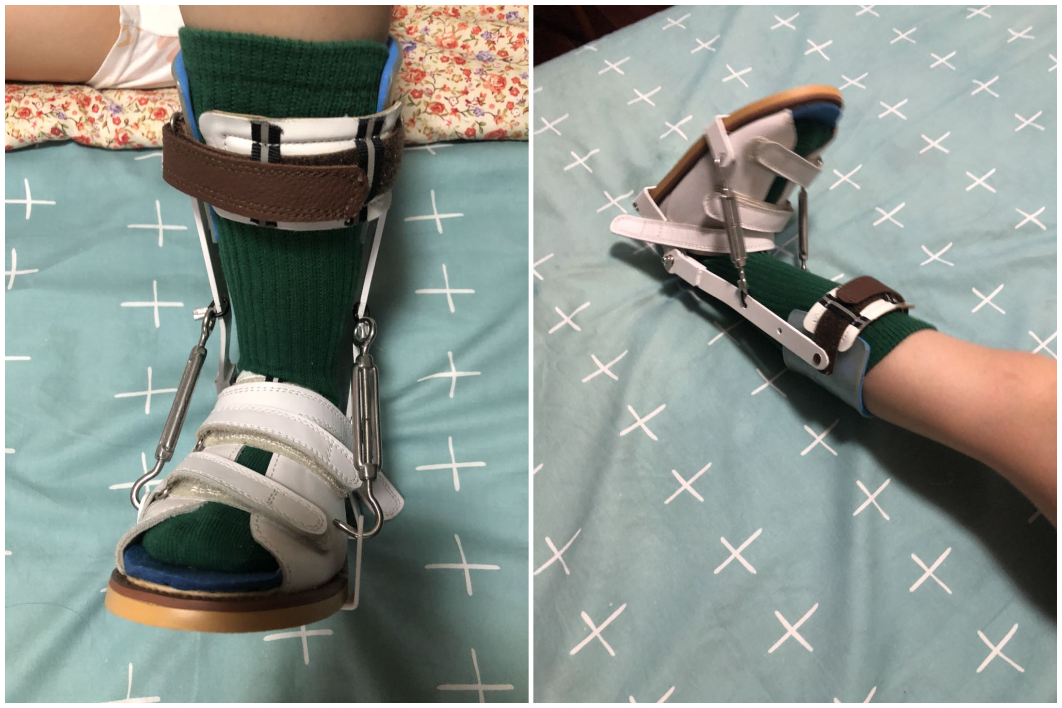 孩子足外翻买什么鞋矫正,儿童足外翻矫正鞋去哪里做