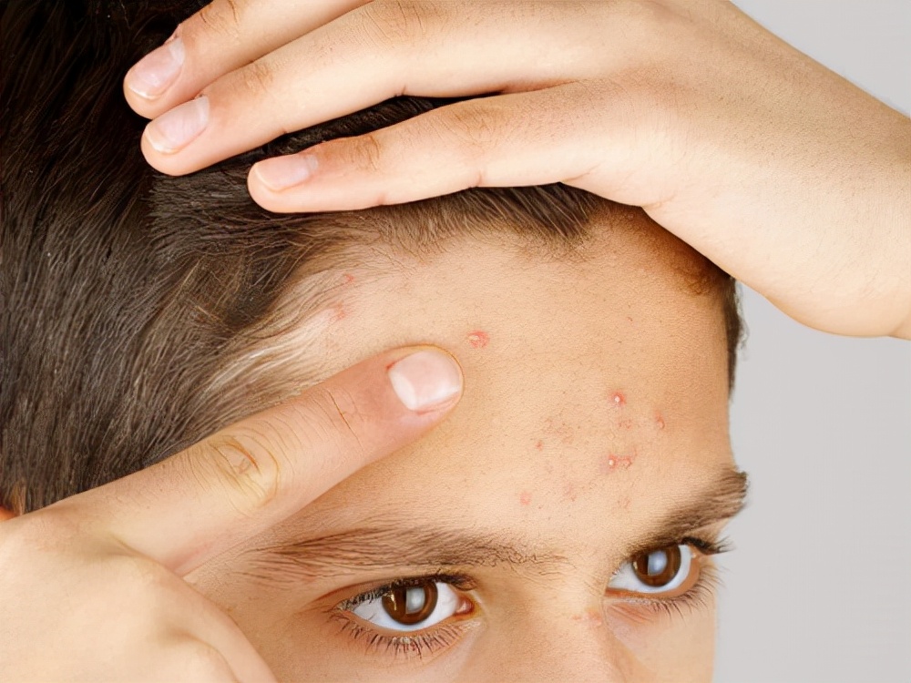 额头爆痘是为啥？找馨漫之舍彻底解决痘痘