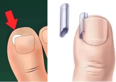 指甲老往肉里长化脓,指甲为什么一直往肉里长