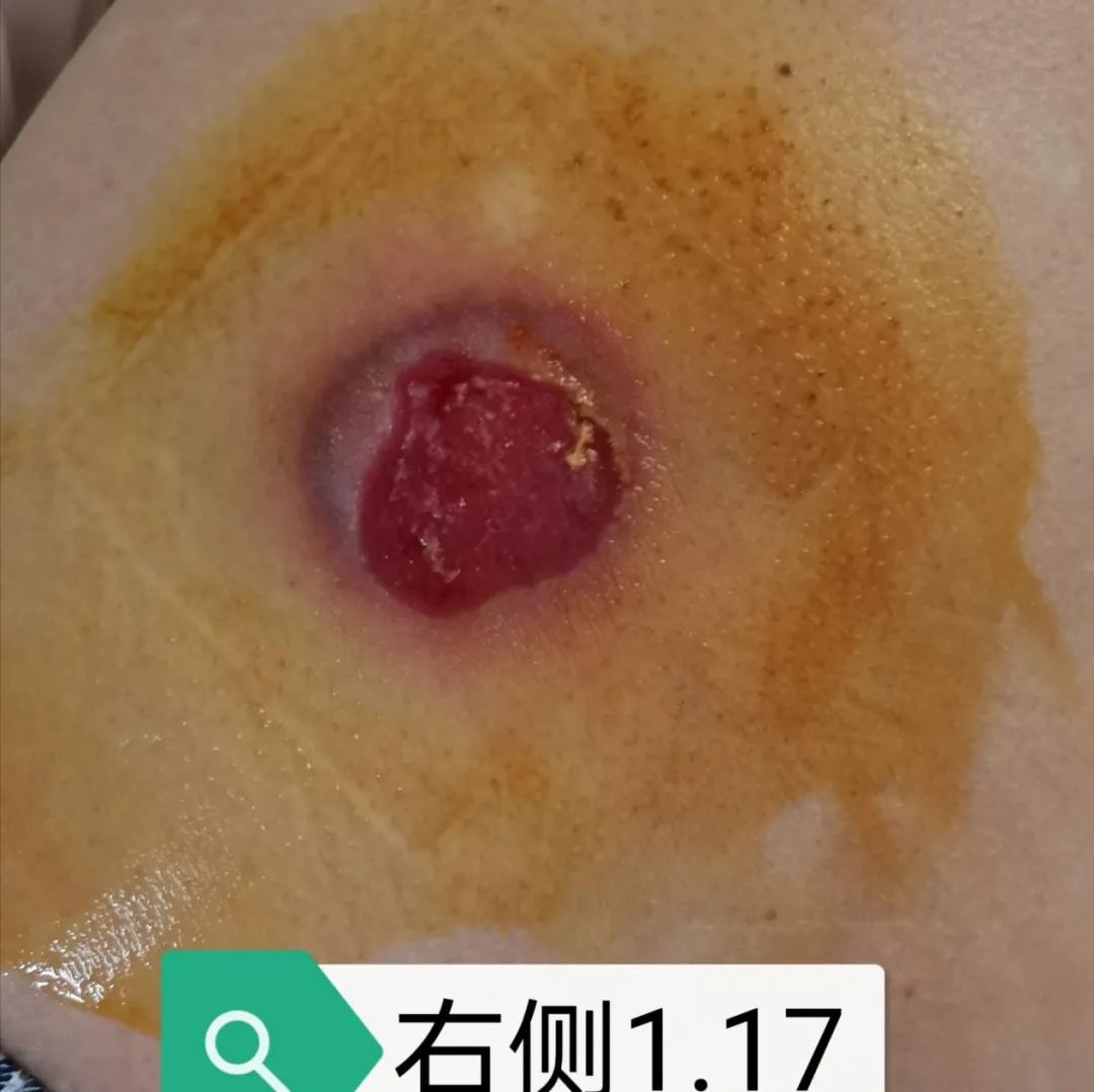 压疮的治疗成功和护理案例,压疮怎么护理好得快