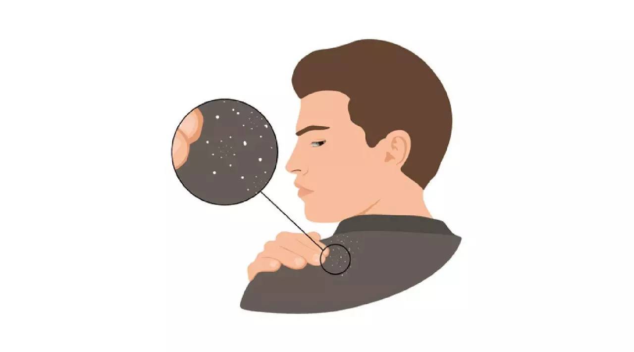 樊哥:为什么每天洗头还会有头皮屑?