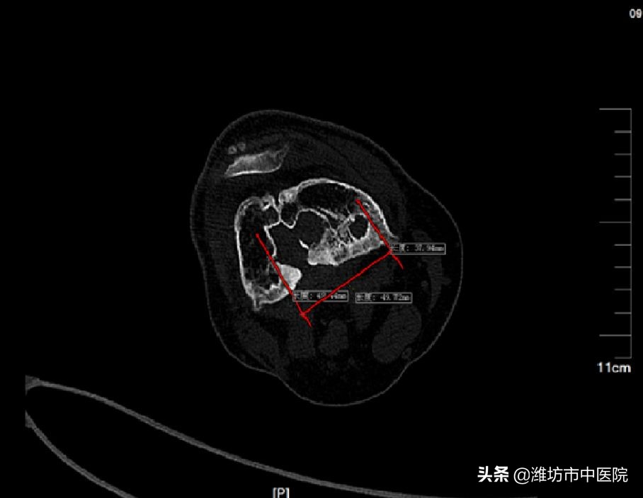 慢性骨髓炎是不是终身无法治愈,慢性骨髓炎持续疼痛吗