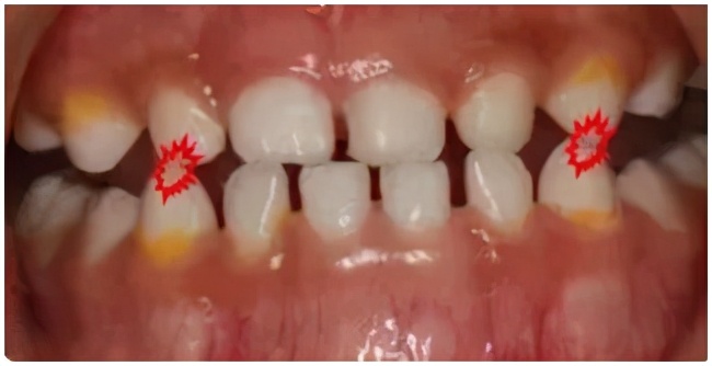 孩子嘴巴地包天有什么说法吗,小孩嘴地包天