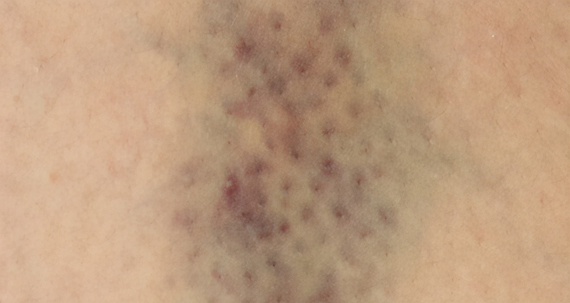 有些人身上无缘无故有淤青,有些人身上总出现淤青怎么回事