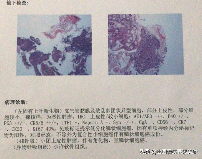 得了肺癌前往美国治疗,肺癌专家去美国治疗过程