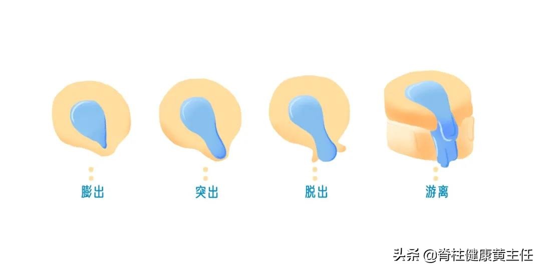 腰椎间盘突出才20岁怎么矫正,腰椎间盘突出7mm可以保守治疗吗