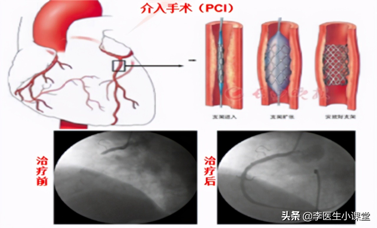 突发心梗最佳自救方法视频,如果突发心梗怎么办急救措施