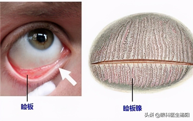 睑板腺一点都没有是什么病,眼睛睑板腺消失严重不