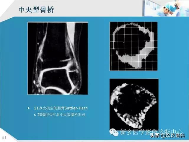 骨骺损伤x线表现,骨骺损伤磁共振表现