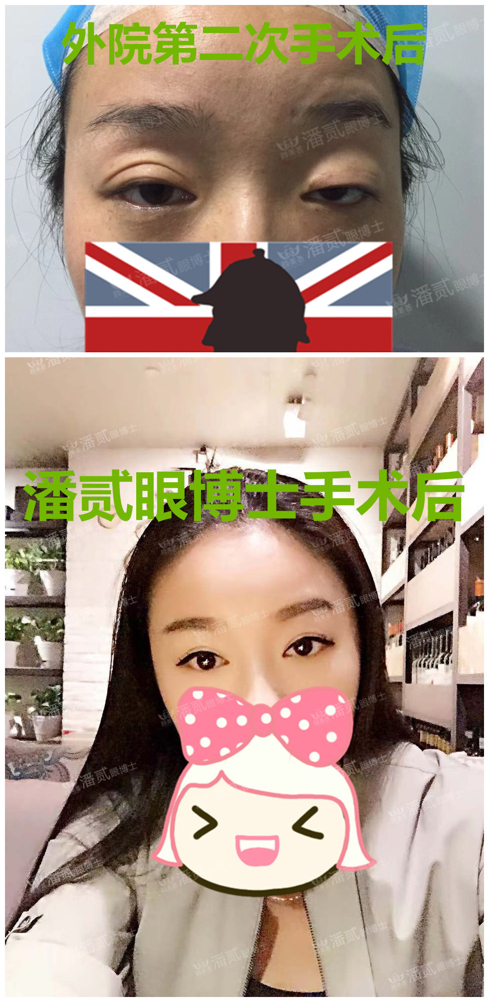 提肌矫正失败的表现眼皮睁不开,做完提肌眼睛前半段下垂