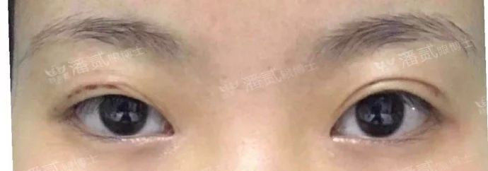 全切双眼皮提肌失败还能修复吗,什么是失败的双眼皮