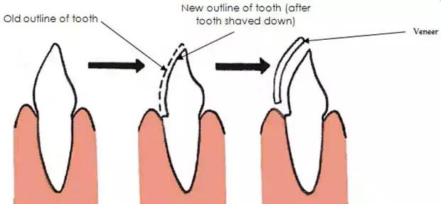 瓜子吃多了会牙齿痛吗,长期吃瓜子对牙齿有影响吗