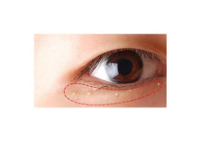 鼻子上挤出来的白色水是什么,鼻子上的油脂挤出后留下的东西