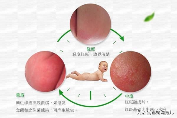 宝宝红屁股反复抹什么药,宝宝反复红屁股怎么办