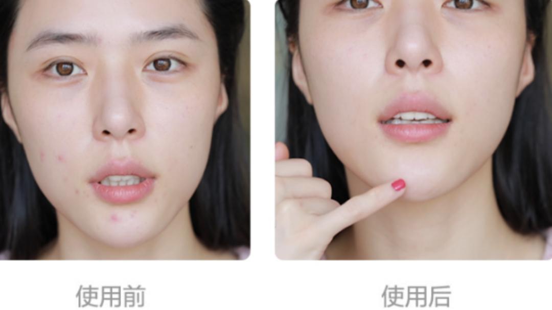 有效祛痘印的痘痘贴,祛痘痘的药膏明星