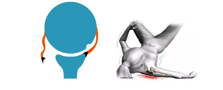 习惯性肩关节脱位怎么办,怎么检查肩关节是不是习惯性脱位