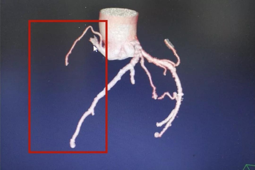 右冠状动脉闭塞多年,右冠状动脉慢性闭塞怎么治疗