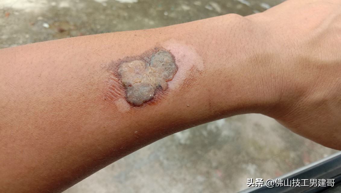 手部烫伤后的康复视频,手烫伤处理视频