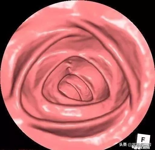 科普胶囊内镜和电子内镜该怎么选,胶囊内镜与无痛胃肠镜区别