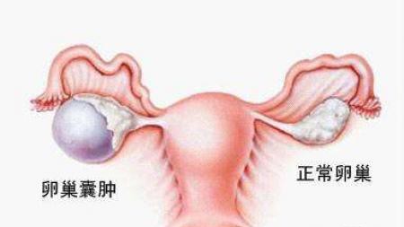 彩超已经显示卵巢囊肿怎么造成的,我最近感觉胸胀胀的怎么回事