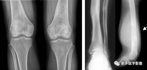 骨骼坏死最佳治疗方法,骨骼疾病治疗