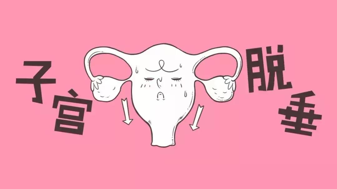 子宫脱垂用仪器有用吗,子宫脱垂除了手术还有别的办法吗