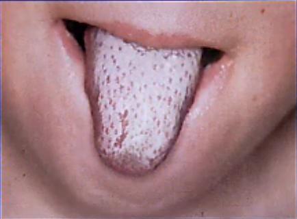 预防猩红热的安全教育,猩红热需要注意的事项