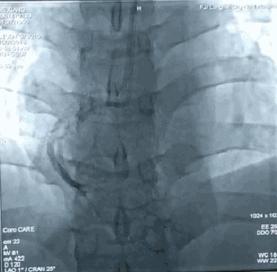 男50岁大量饮酒后突发腹痛,聚餐饮酒后腹痛18小时