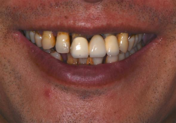 50岁种植牙,50岁了种植牙一颗多少钱