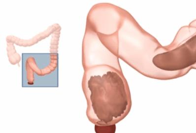 儿童便秘拉不出粑粑怎么办,孩子便秘拉不动