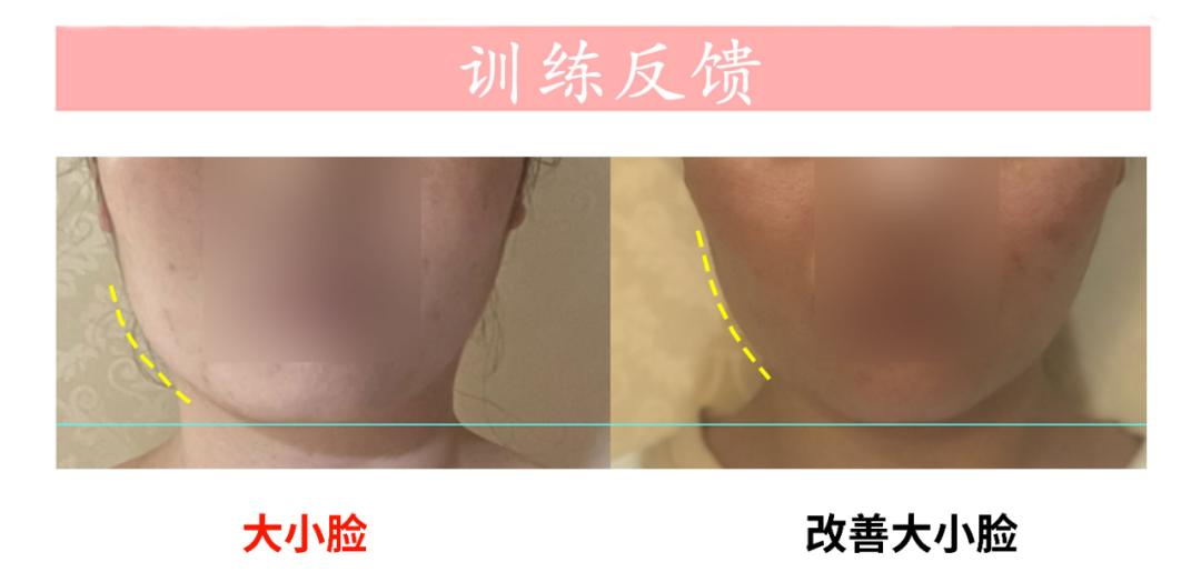 下颌偏歪会引起哪边脸大,下颌紊乱跟大小脸有关系