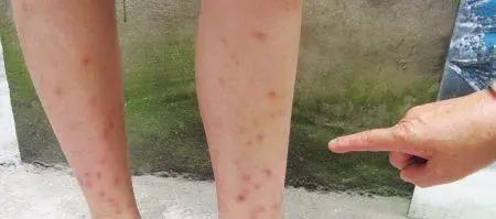 被什么虫子叮了会有一阵的刺痛感,各种虫子叮咬后的症状