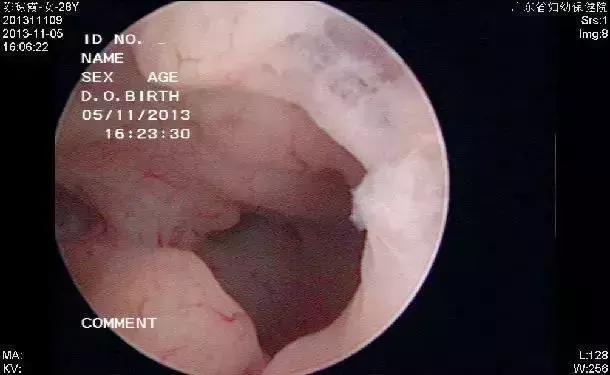 多囊和多囊卵巢综合征是一回事吗,多囊跟多囊卵巢综合征有什么区别