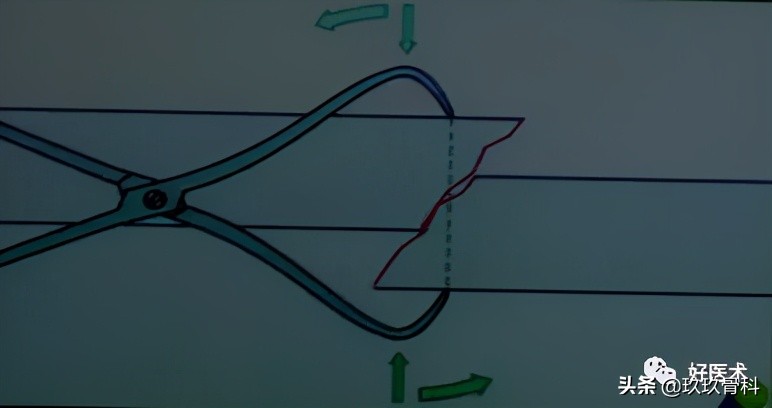 髓内钉技巧,髓内钉教学视频讲解