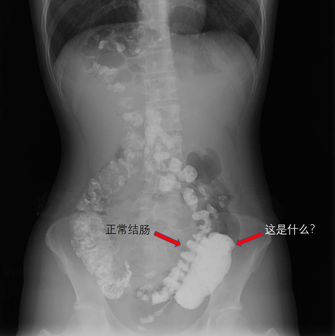 屎粘稠拉不出来什么原因,拉粒粒屎是什么原因
