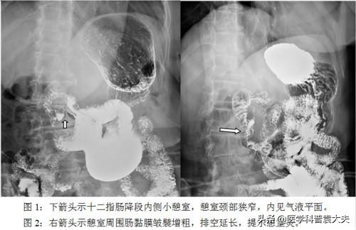 上消化道出血的五种常见病因,双氯芬酸钠引起消化道出血的原因