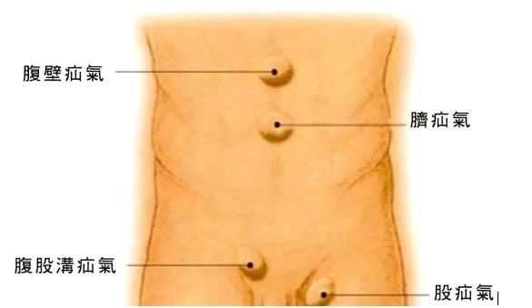 切口小，外观佳，恢复快——治疗疝气，了解下腹腔镜疝修补术