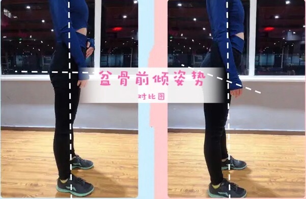 骨盆前倾引起的腰痛如何缓解,如何缓解久坐带来的腰酸腰痛