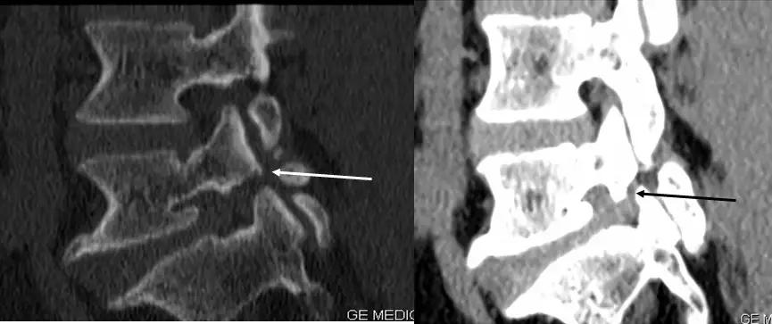 颈椎腰椎疾病ct及mri诊断,腰椎ct可以发现肠部病变吗