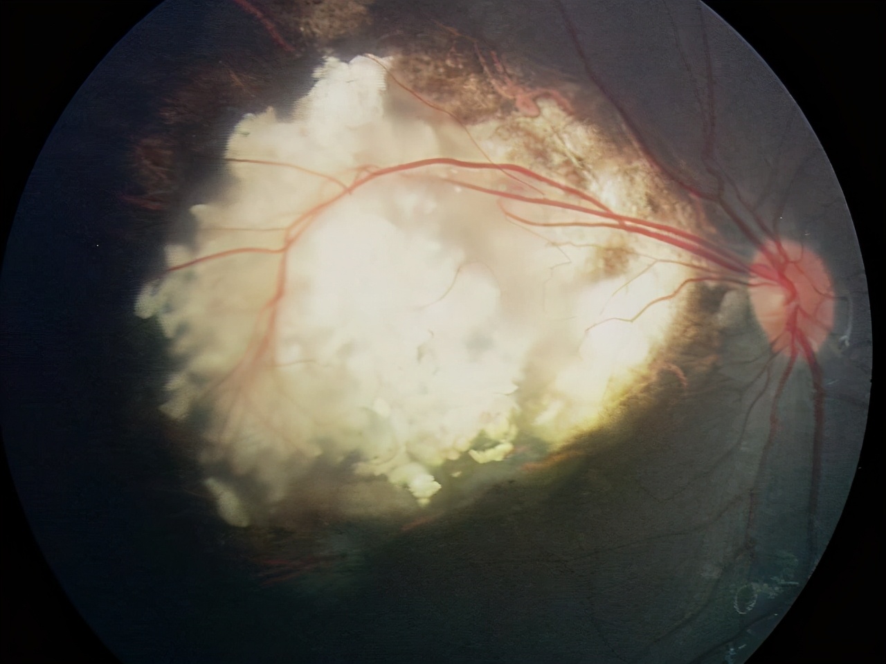 视网膜母细胞瘤恶性肿瘤,视网膜母细胞瘤是什么遗传病