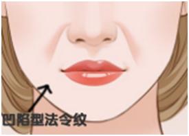 法令纹都是有什么方法可以去除,去法令纹最有效的办法明星