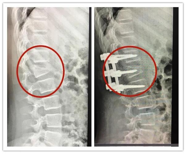 高位截瘫小孩10岁康复训练,小孩高位截瘫功能锻炼