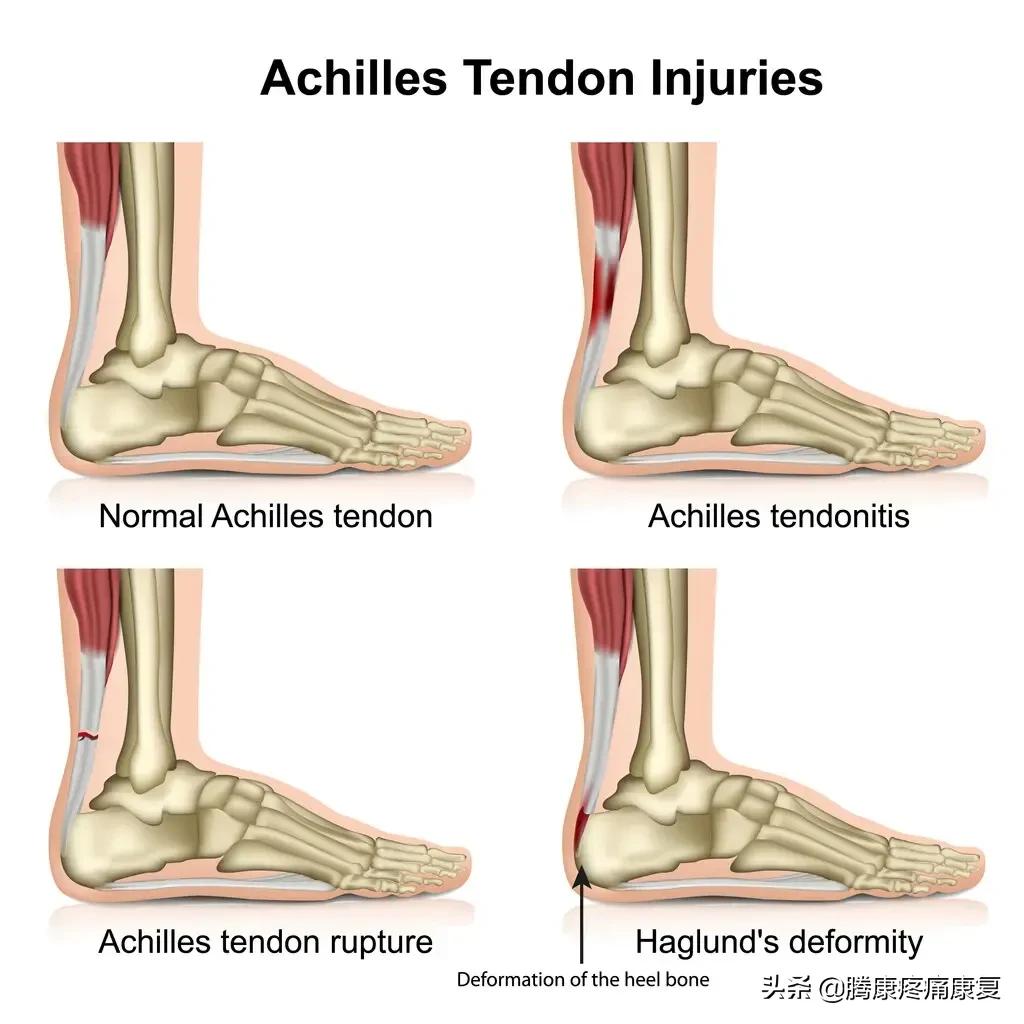 跟腱炎如何预防,跑步怎样预防跟腱炎