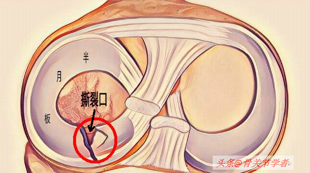 磁共振怎么看半月板损伤程度,磁共振半月板损伤1级是什么