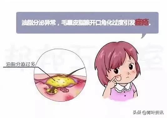 孕期长痘痘的原因和解决方法,孕期长痘痘很严重怎么办