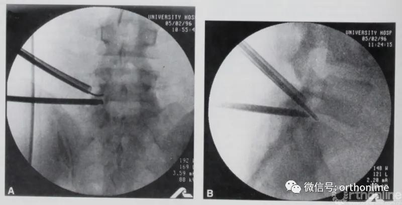 从“脊髓镜”谈到UBE/BESS:追溯脊柱内镜演化史(上)