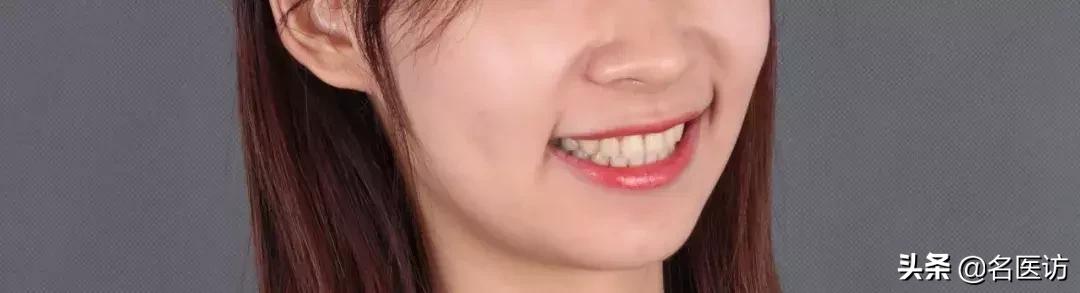 戴牙套2年不戴保持器反弹案例,戴牙套成功案例不戴保持器