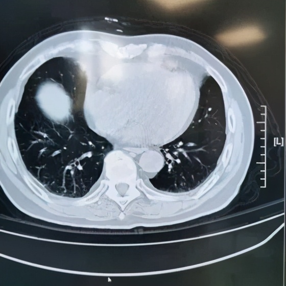 阵发性房颤和用药有关系吗,房颤药物控制好了还会复发吗